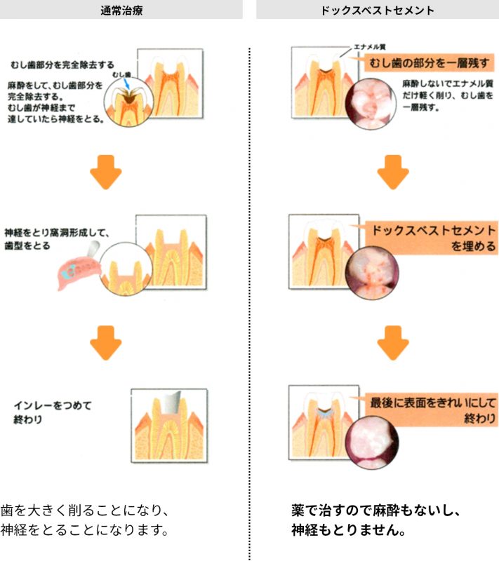 ドックスベストセメント